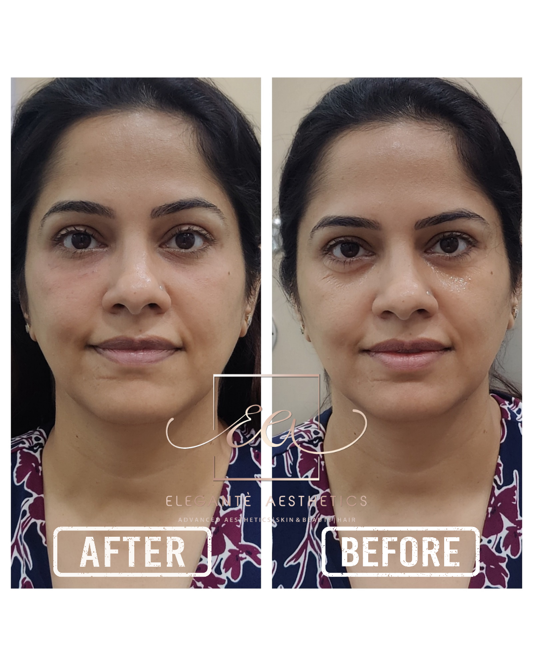 Chemical Peel before and after result — Elegantè Aesthetics