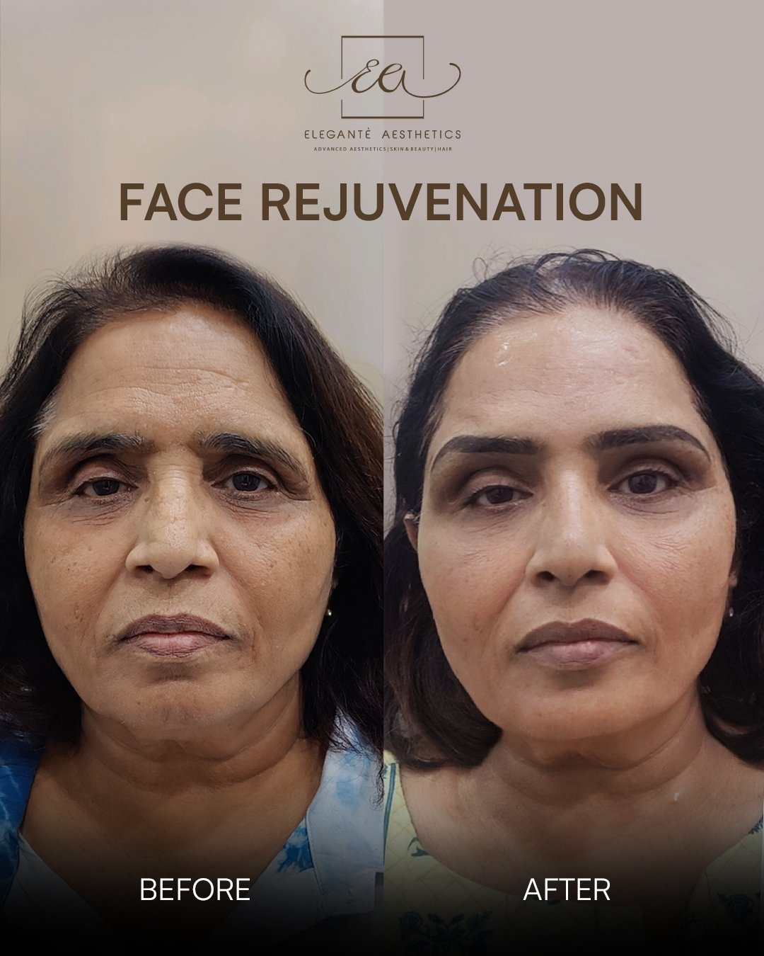Dermal Fillers under-eye before and after result — Elegantè Aesthetics