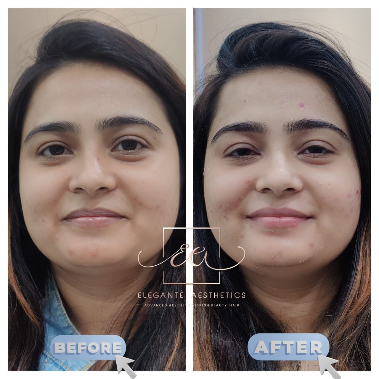 Botox and anti-wrinkle before and after result — Elegantè Aesthetics