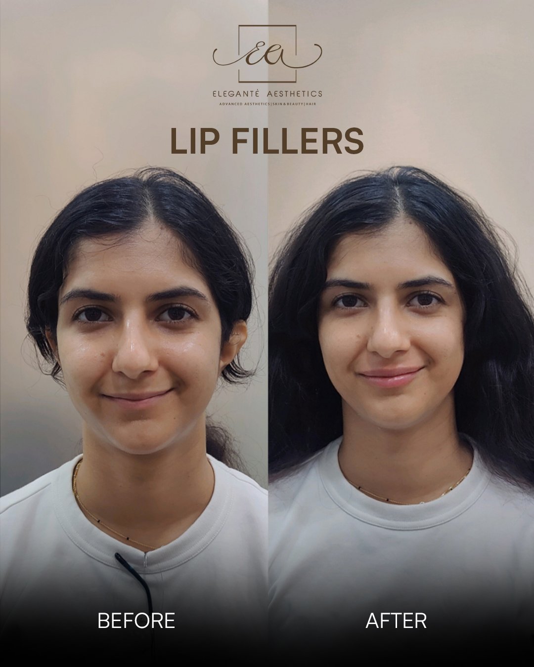 Lip Fillers before and after result — Elegantè Aesthetics