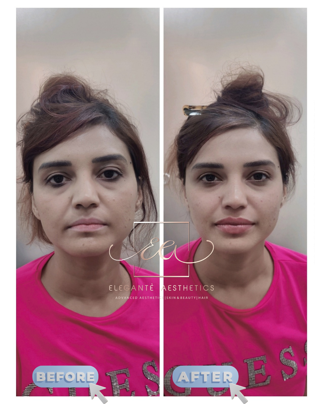 Profhilo bio-remodeling before and after result — Elegantè Aesthetics